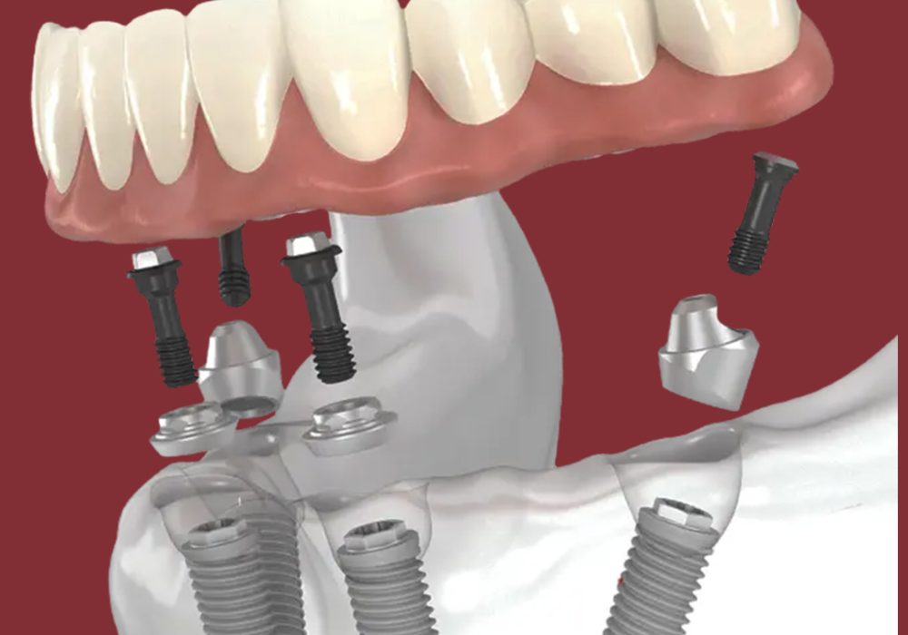 Full Arch (All on 4) Implants